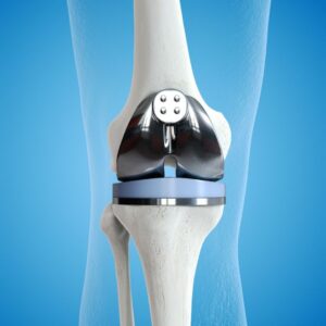 Knee Replacement Recovery and Implant Durability