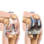 Knee replacement surgery showing artificial knee joint implant and alignment