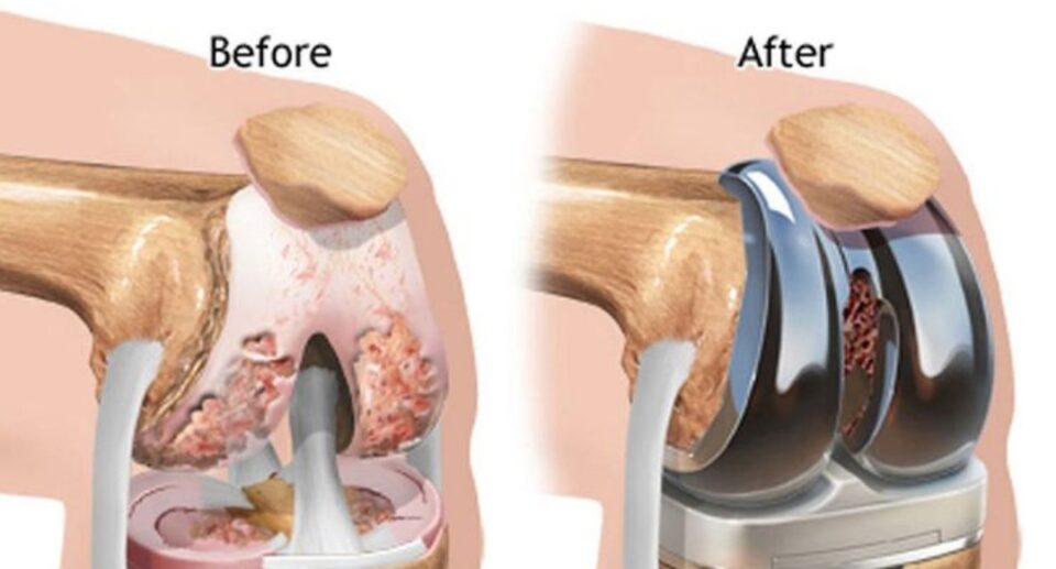 How Long Does a Knee Replacement Last?
